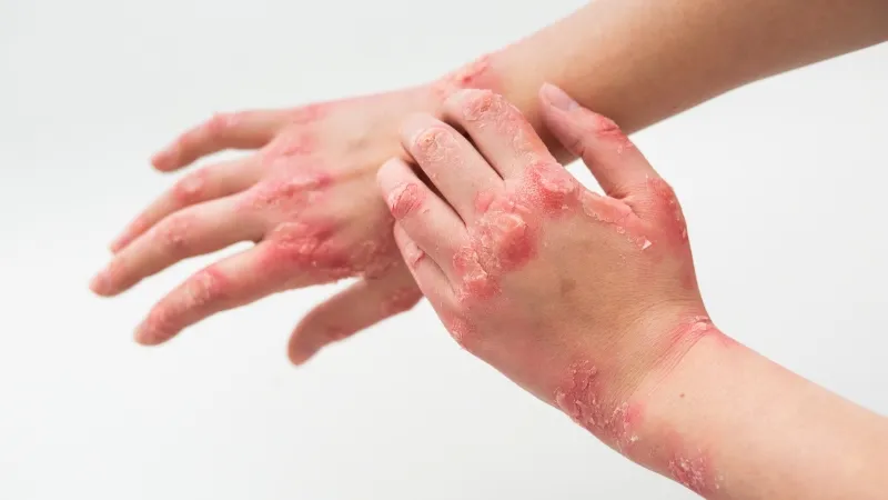 Eczema (Atopic Dermatitis): Everything You Need to Know About Symptoms, Causes and Treatment