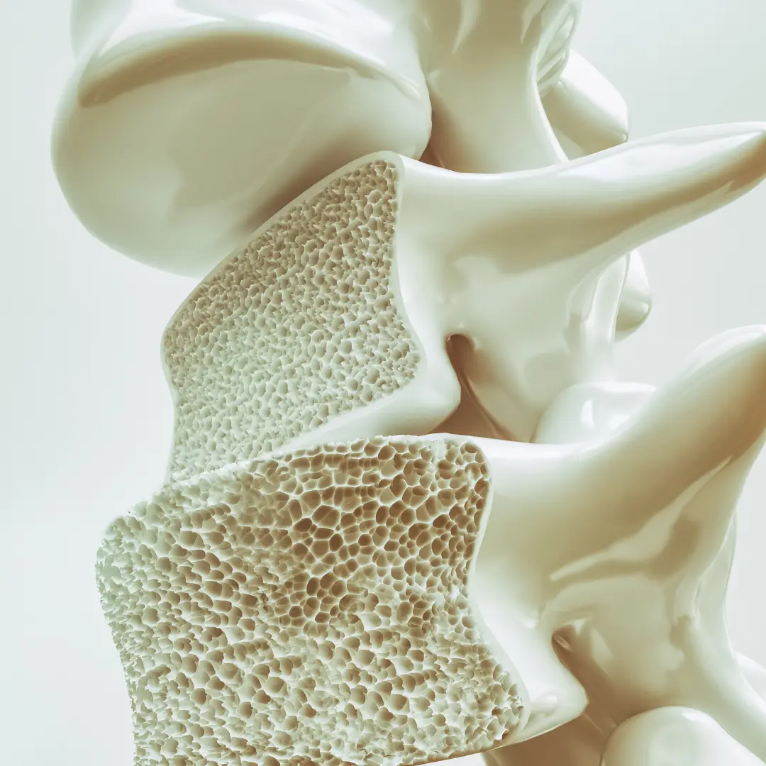Osteoporosis: Causes, Symptoms & Effective Treatment for Better Bone Health