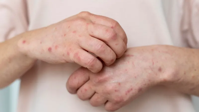Monkeypox: It’s Symptoms, Causes, Treatment and Prevention