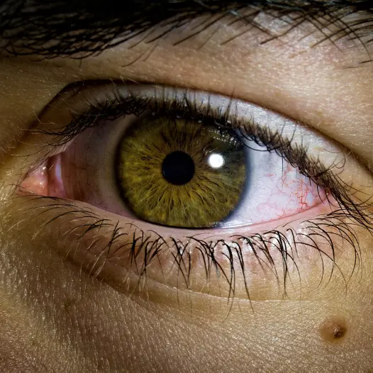 Jaundice: Symptoms, Causes & Effective Treatment Options